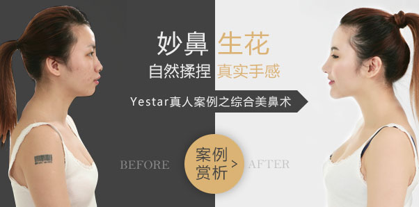 鼻部整容种草