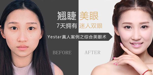 眼部整容种草